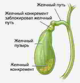 желчный пузырь и камни