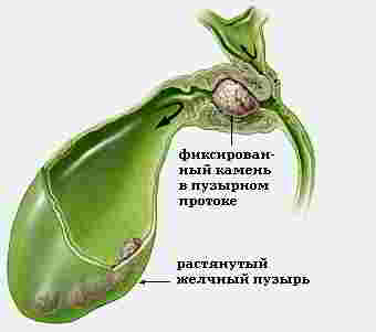 желчная колика и воспаление желчного пузыря