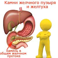 камни желчного пузыря и желтуха у человеска