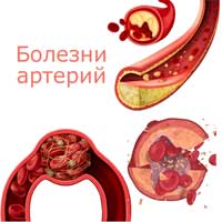 болезни артерий