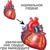 сердце при миокардите