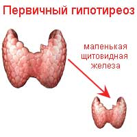 Первичный гипотиреоз презентация