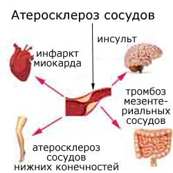 атеросклероз сосудов разной локализации