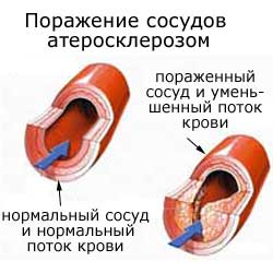 поражение сосудов атеросклерозом