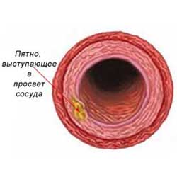 первая стадия атеросклероза сосудов