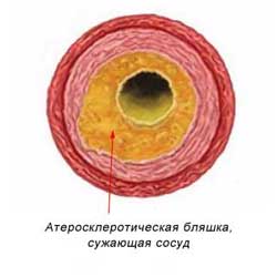вторая стадия атеросклероза сосудов