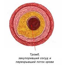 третья стадия атеросклероза сосудов
