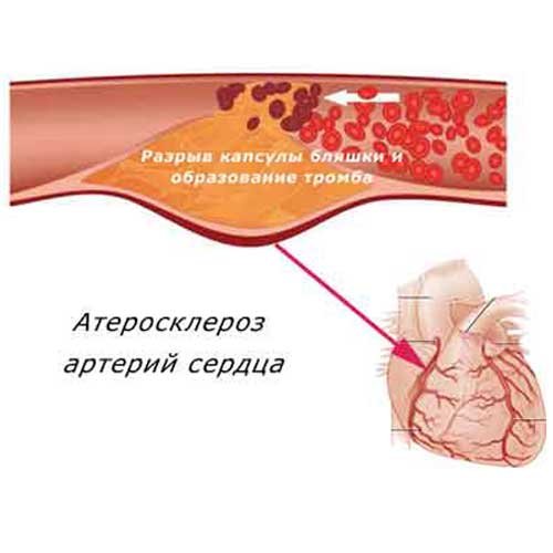 атеросклерозом поражены коронарные артерии