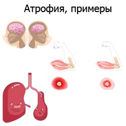 атрофия, примеры