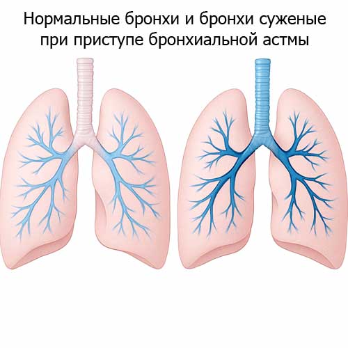 сужение бронхов при приступе бронхиальной астмы