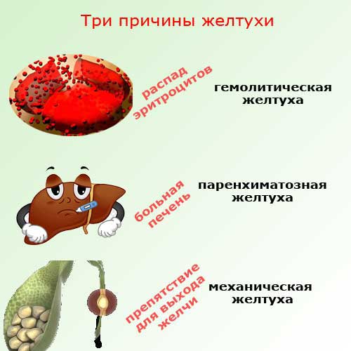 три причины желтухи, схема