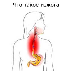 что такое изжога