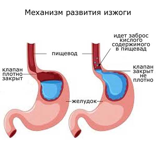 механизм развития изжоги