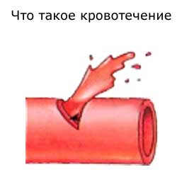 кровотечение