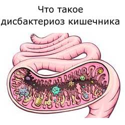 дисбактериоз кишечника