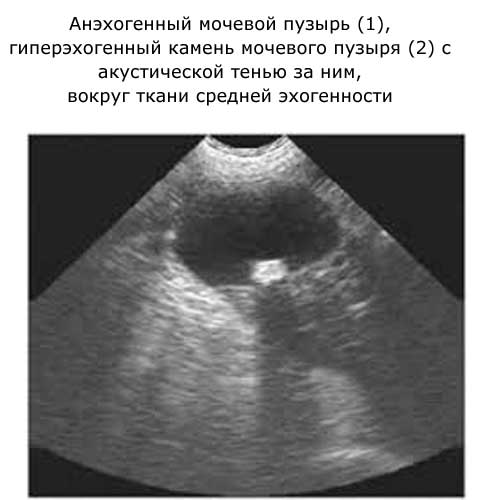 мочевой пузырь, камень - структуры разной эхогенности