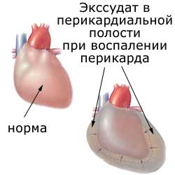 экссудат в перикардиальной полости