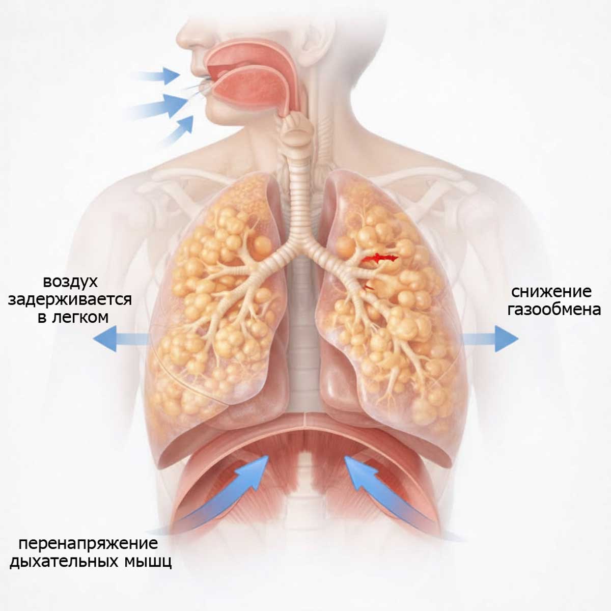 3D-медицинская схема дыхательной системы при эмфиземе легких, показан механизм одышки