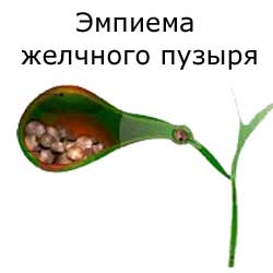 эмпиема желчного пузыря