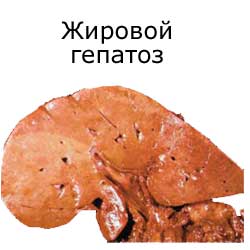 жировой гепатоз