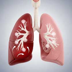 хроническая обструктивная болезнь легких