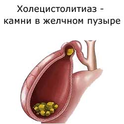 холецистолитиах - камни в желчном пузыре