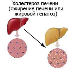 холестероз печени