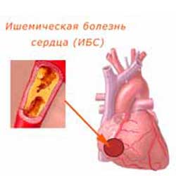 ишемическая болезнь сердца