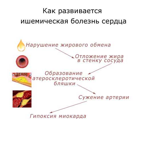как развивается ишемическая болезнь сердца