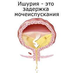ишурия или задержка мочеиспускания