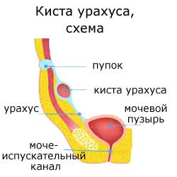 киста урахуса, схема