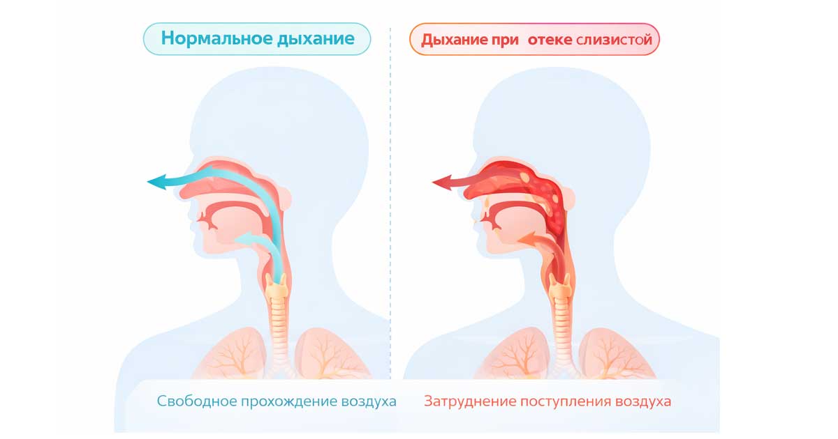 Сравнение нормального дыхания и дыхания при отеке слизистой верхних дыхательных путей.