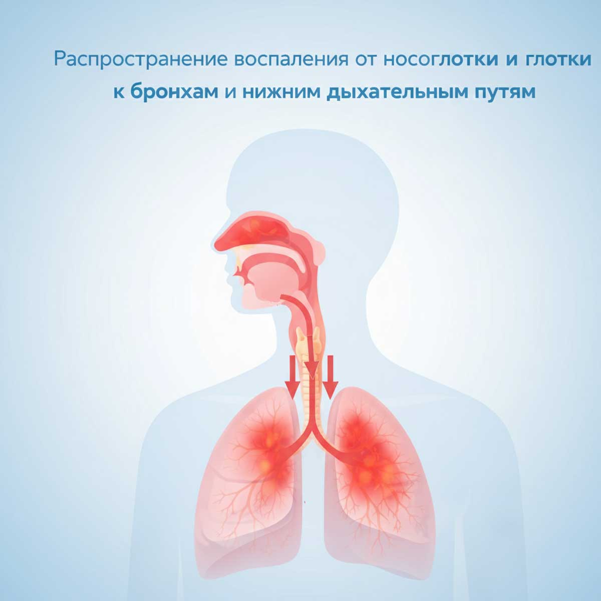Инфографика распространения воспаления от верхних дыхательных путей к нижним