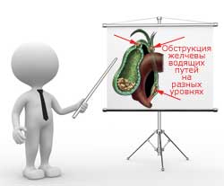 обструкция желчевыводящих путей на разных уровнях