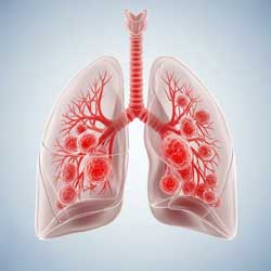 легкие, пневмония