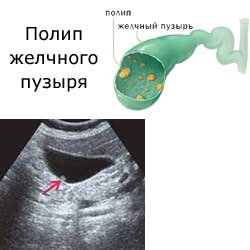 полип желчного пузыря