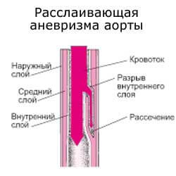 расслаивающая аневризма аорты