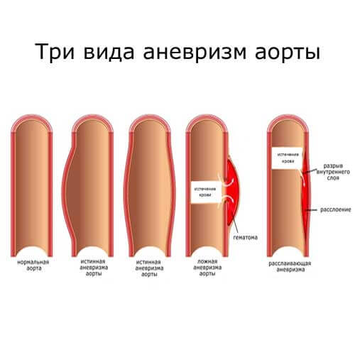 три вида аневризмы аорты