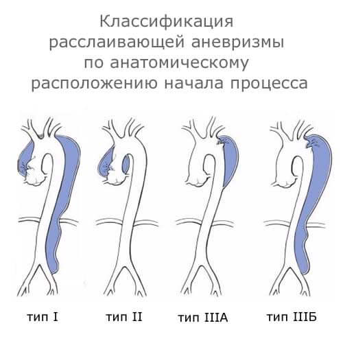 классификация расслаивающей аневризмы по анатомическому расположению начала процесса