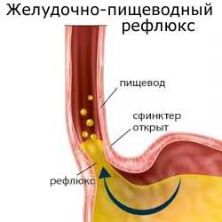 желудочно-пищеводный рефлюкс