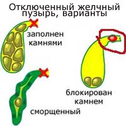 отключенный желчный пузырь, варианты