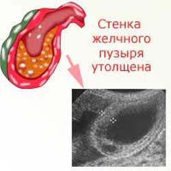 стенка желчного пузыря утолщена