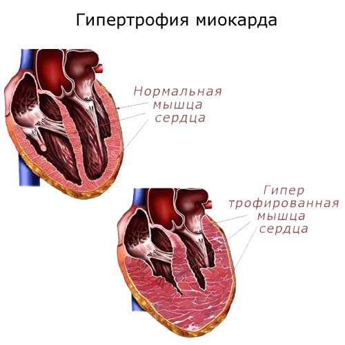гипертрофия миокарда
