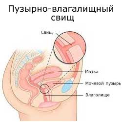 свищ между мочевым пузырем и влагалищем