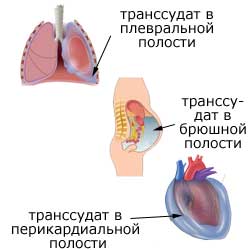 транссудат в плевральной, брюшной и перикардиальной полостях
